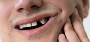 From Gaps to Great Smiles: Missing Tooth Treatment Explained 1 From Gaps to Great Smiles: Missing Tooth Treatment Explained