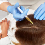 Benefits Of PRP Hair Restoration 1