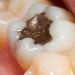 dental filling