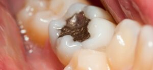 Protect Your Smile with Early Cavity Fillings 1 Protect Your Smile with Early Cavity Fillings