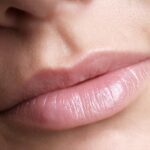 What Makes Lip Reduction Popular for Fuller Lips? 3 What Makes Lip Reduction Popular for Fuller Lips?