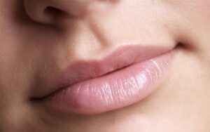 What Makes Lip Reduction Popular for Fuller Lips? 1 What Makes Lip Reduction Popular for Fuller Lips?