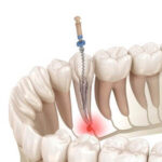 Root Canal Before and After treatment