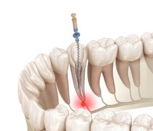 How a Single Sitting Root Canal Saves Time and Teeth