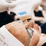 BBL Laser In Manchester – Advanced Skin Rejuvenation for Clear, Youthful Skin