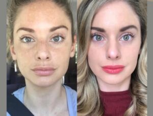 Achieve Glowing Skin with Radiofrequency (RF) Microneedling Treatment in Dubai 1 Achieve Glowing Skin with Radiofrequency (RF) Microneedling Treatment in Dubai