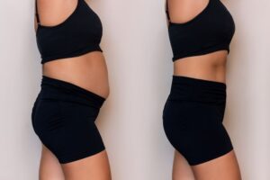 Can Liposuction Support a More Sculpted Silhouette?