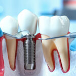 How Dental Implant Treatment Restores Your Smile 3 How Dental Implant Treatment Restores Your Smile