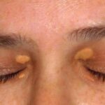Eyelid Xanthelasma Removal: Best Time to Get Treatment