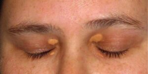 Eyelid Xanthelasma Removal: Best Time to Get Treatment