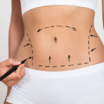 Liposuction in Abu Dhabi