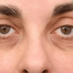 Eye Bag Removal: Benefits Beyond Appearance