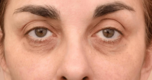Eye Bag Removal: Benefits Beyond Appearance