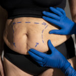 What Makes Tummy Tuck in Islamabad So Popular?
