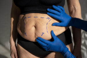 What Makes Tummy Tuck in Islamabad So Popular? 1 What Makes Tummy Tuck in Islamabad So Popular?