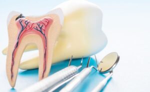 Best Clinic for Root Canal Treatment in Sinhagad Road Pune