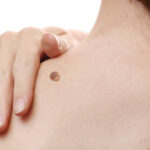 Mole9