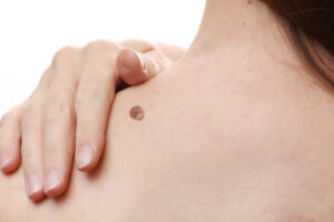 Mole Removal in Dubai: 5 Myths Debunked
