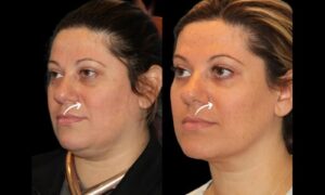 Best Doctors in Dubai for Sculptra Fillers and Beauty Tech Innovation