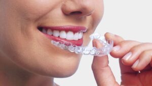 Benefits of Choosing Invisible Braces for Your Smile 1 Benefits of Choosing Invisible Braces for Your Smile
