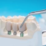 Dental implant