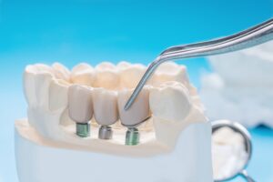 Dental Implants in Solapur | Permanent Tooth Replacement