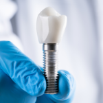 Dental Implants A Permanent Solution for Missing Teeth