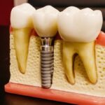 dental implant 2.0