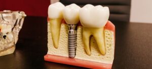 Affordable Dental Implant Treatment in Hubli | Shree Vishwa Vande Dental Clinic