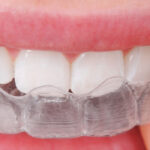 Top Advantages of Choosing Invisible Braces 3 Top Advantages of Choosing Invisible Braces
