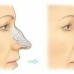 Rhinoplasty Specialist in Delhi %E2%80%93 Why Patients Trust Dr. Vivek Kumar for Natural and Balanced Facial Results