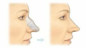 Rhinoplasty Specialist in Delhi – Why Patients Trust Dr. Vivek Kumar for Natural and Balanced Facial Results
