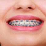 How Do Braces Gradually Shift Teeth Into Proper Alignment?