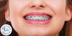 How Do Braces Gradually Shift Teeth Into Proper Alignment?