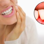 Bleeding Gums? Here’s How To Treat Them