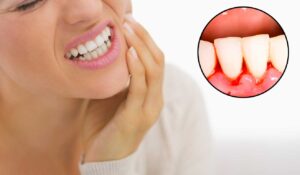 Bleeding Gums? Here's How To Treat Them 1 Bleeding Gums? Here’s How To Treat Them