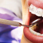 Braces Treatment Explained: What to Expect