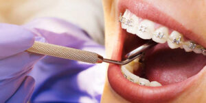 Braces Treatment Explained: What to Expect 1 Braces Treatment Explained: What to Expect