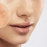 Acne Scars Treatment in Delhi %E2%80%93 Advanced Solutions for Clearer and Smoother Skin