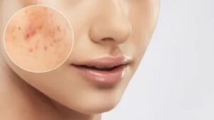 Acne Scars Treatment in Delhi – Advanced Solutions for Clearer and Smoother Skin