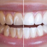 How To Keep Your Teeth White After Professional Teeth Whitening
