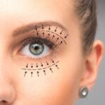 Eyelid Surgery in Islamabad for Droopy Eyelids: What to Expect