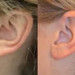 Earlobe Correction: Understanding Surgical Techniques