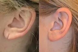 Earlobe Correction: Understanding Surgical Techniques 1 Earlobe Correction: Understanding Surgical Techniques