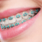 rubber bands for braces scaled 1 1