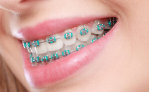 Bold Smile Dental Braces in Dubai brilliant smile confidence boost 1 Bold Smile Dental Braces in Dubai brilliant smile confidence boost