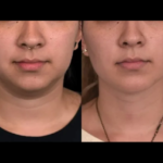 Best Cosmetic Procedures to Pair With Double chin removal Surgery in dubai