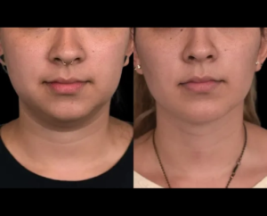 Best Cosmetic Procedures to Pair With Double chin removal Surgery in dubai