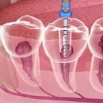 root canal treatment