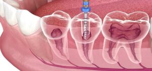 Why Is My Tooth Still Sensitive After a Root Canal?